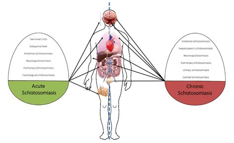 JCM | Free Full-Text | Clinical Spectrum of Schistosomiasis: An Update