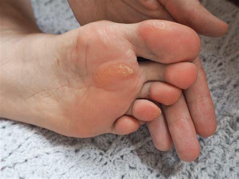 The calluses on the feet: how to reduce them with 7 natural remedies