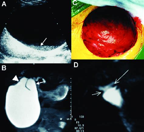 A. A huge dilatation of the common bile duct containing bile sludge ...