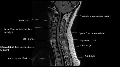 FLAIR vs STIR MRI | FLAIR vs STIR MRI image comparison