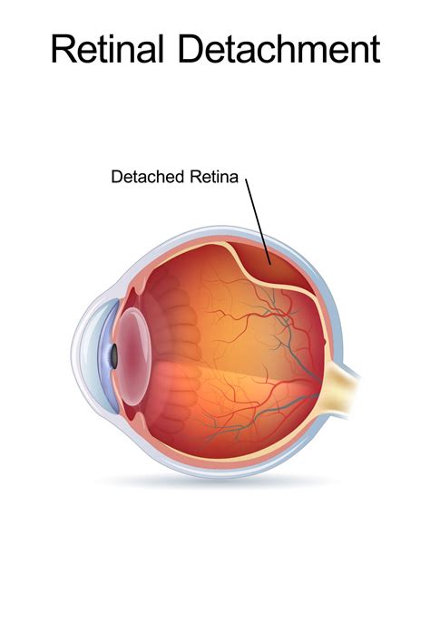 Nashville, TN Retinal Detachment Signs and Symptoms: Causes and Treatments