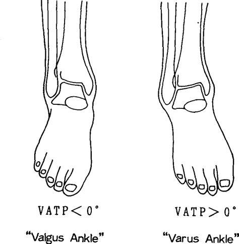 Valgus Vs Varus Of Ankle