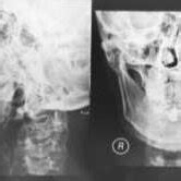 Sialograph, blue arrow show sialolithiasis | Download Scientific Diagram