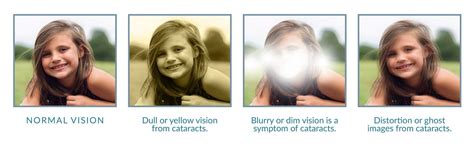 Cataract Causes and Treatment - Piedmont Eye Center