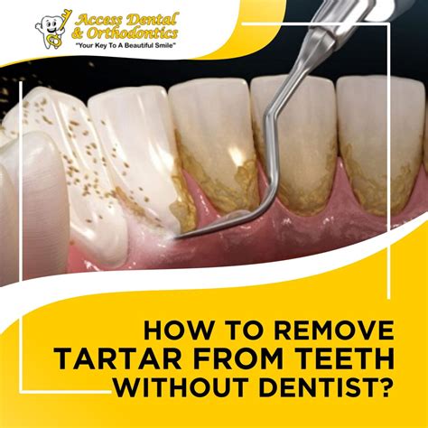 How to Remove Plaque & Tartar From Teeth (Without Dentist)