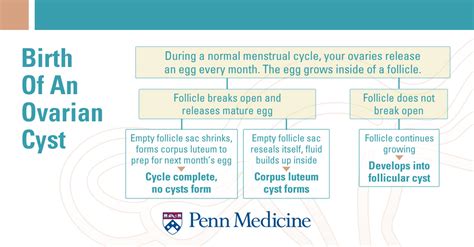 Ovarian Cyst - Symptoms and Causes