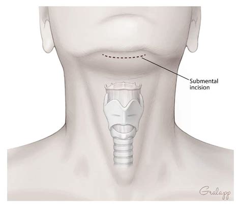 Adam’s Apple Reduction / Removal for Feminization (Tracheal Shave ...