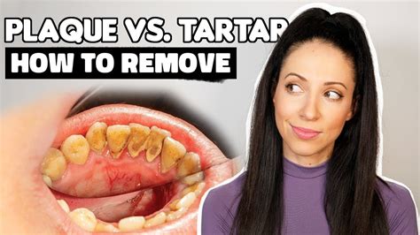 Plaque vs. Tartar | How To Remove Plaque From Teeth - YouTube