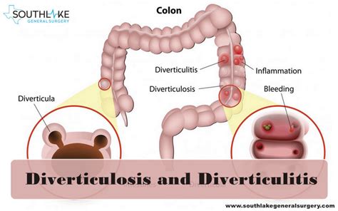 Laparoscopic Diverticulitis Surgery & Recovery- Southlake General Surgery