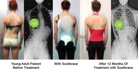 Scoliosis Treatment and Options | Spine and Scoliosis Clinic