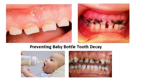 Preventing Baby Bottle Tooth Decay | kidschildren