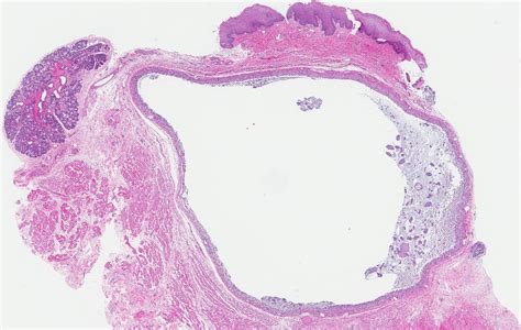 Mucocele Histology