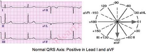 Determine Axis on a 12-lead ECG Tracing | LearntheHeart.com