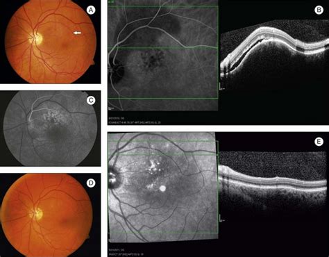 Circumscribed Choroidal Hemangioma | Ento Key