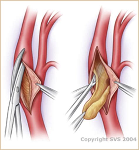 Carotid Endarterectomy - Vascular Disease Treatment