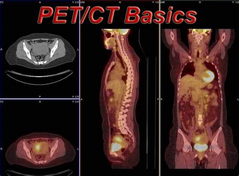 Pet Scan Lymphoma Staging - Pet Spares