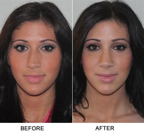 Turbinate nose surgery 3 - Liposuction before and after | Nose surgery ...