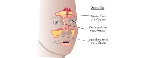 London ENT Associates | Sinusitis and Sinus Surgery