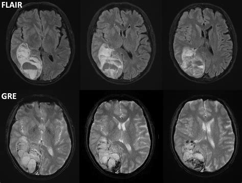 Ischemic Stroke Mri