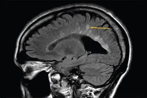 Dawson's Finger in Multiple Sclerosis