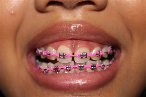 Life, Love, Everything: Braces UPDATE!