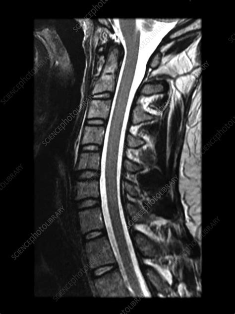 Normal MRI Cervical Spine - Stock Image - C043/0139 - Science Photo Library