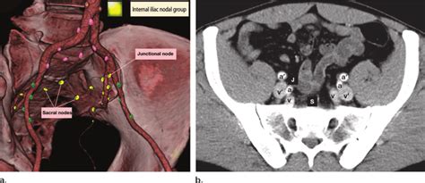 Internal iliac lymph node group. Illustration (a) and axial ...