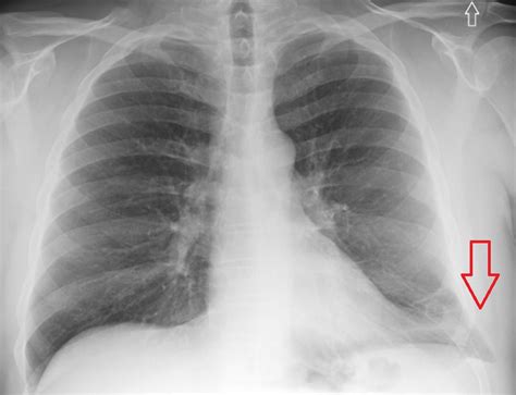 Cureus | Lung Herniation Associated With Crack Cocaine Use: An Uncommon ...