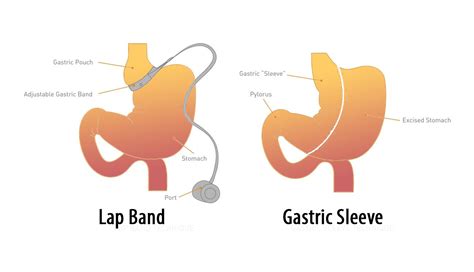 Comparing Objectively the Gastric Sleeve Vs Gastric Bypass