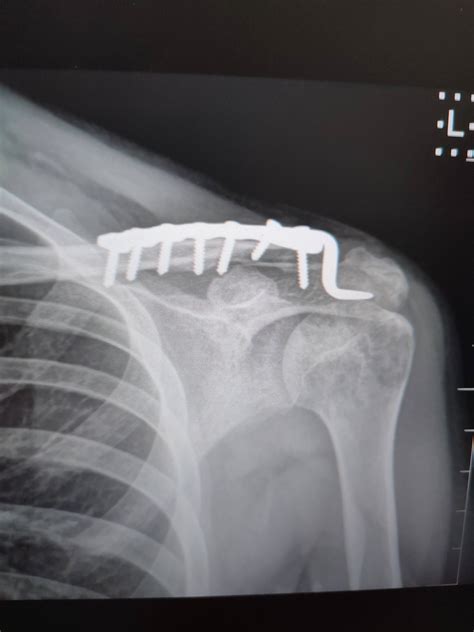 After 6 months, I finally had my hook plate removed from my clavicle ...