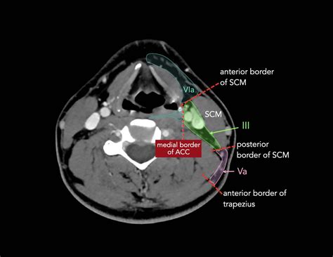 Distribution Pattern And Prognosis Of Metastatic Lymph, 49% OFF