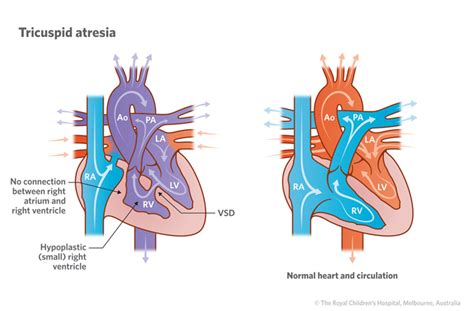 Cardiology : Tricuspid Atresia