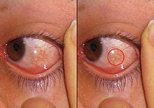 Chemosis - Wikipedia