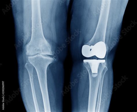 Osteoarthritis Knee ( OA Knee ) comparison on left arthroplasty / total ...