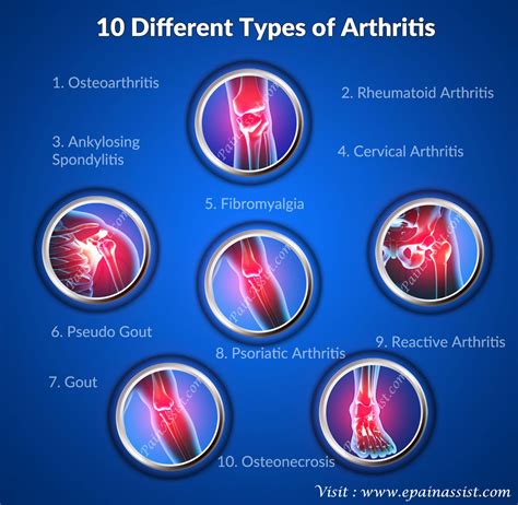 Rheumatoid arthritis stories: What Are the Types of Arthritis?