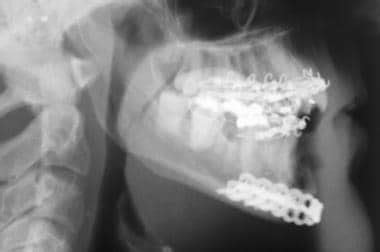 Mandibular Fracture X Ray