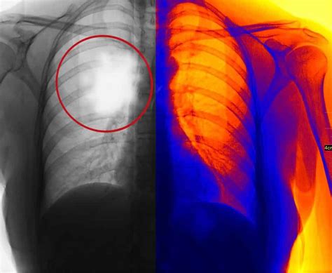 Pleural Mesothelioma Cancer | Symptoms, Prognosis, & Treatment