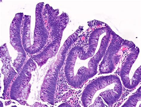 Tubular Adenoma Histology