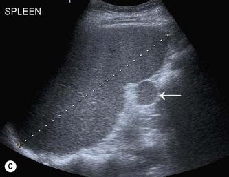 Normal Spleen Ultrasound