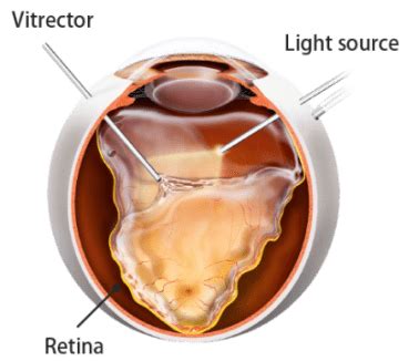 Pars Plana Vitrectomy - Fairfield, CT & Hamden, CT: Connecticut Retina ...