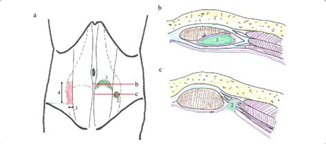 Anatomical location of arcuate line hernia (1) and Spigelian hernia ...