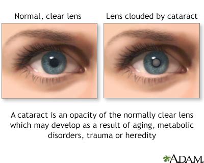 Cataract removal Information | Mount Sinai - New York