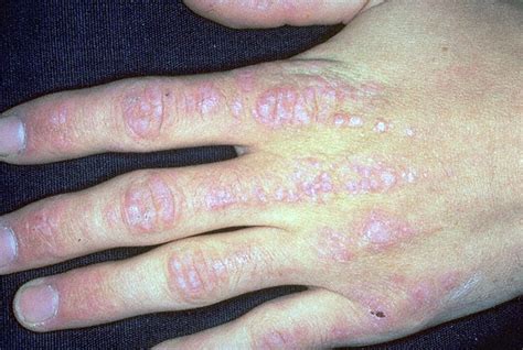 The Pulse: Dermatomyositis