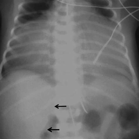 Chest radiograph 24 hours after repair of Bochdalek hernia. The grossly ...