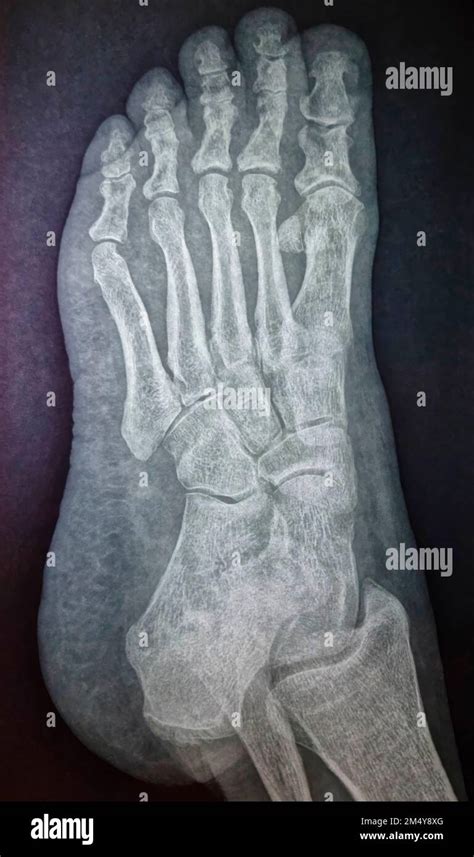 X-ray image of foot, radiography of food bones Stock Photo - Alamy