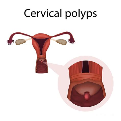 Cervical Polyps Photograph by Veronika Zakharova/science Photo Library