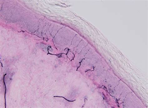 Small Fiber Neuropathy Overview - Therapath Neuropathology