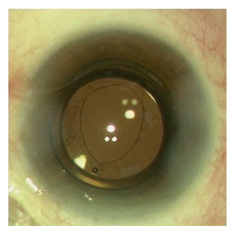 Illustration of posterior capsulotomy using capsular forceps from the ...