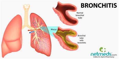 Bronchitis: Causes, Symptoms And Treatment