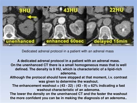 Adrenal gland tumors (Radiology)